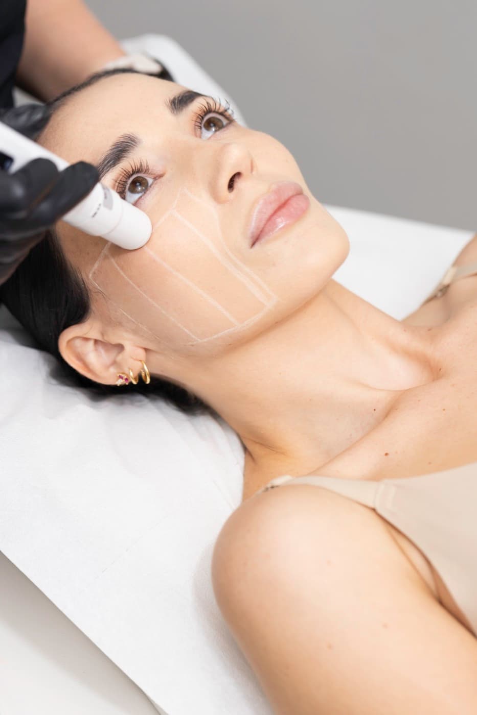 Radiofrecuencia Facial